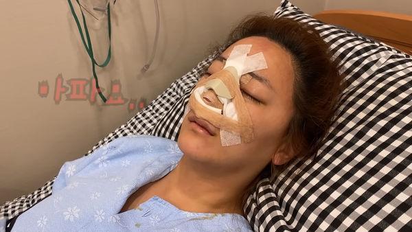 韩女星「鼻子整失败忍10几年」！花80万再动刀　术后照超惊人(图2)